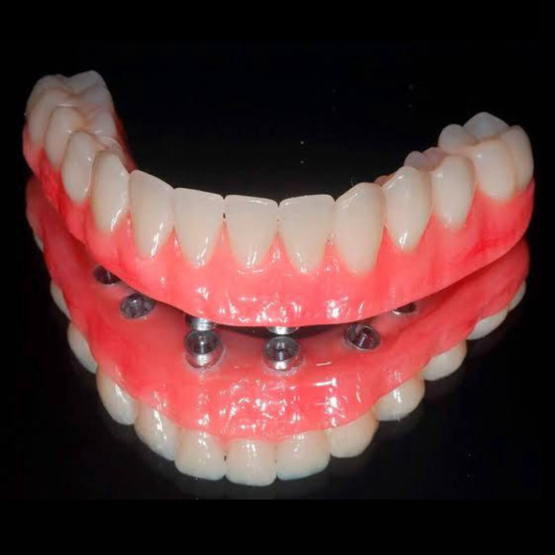 implante dentário (1)