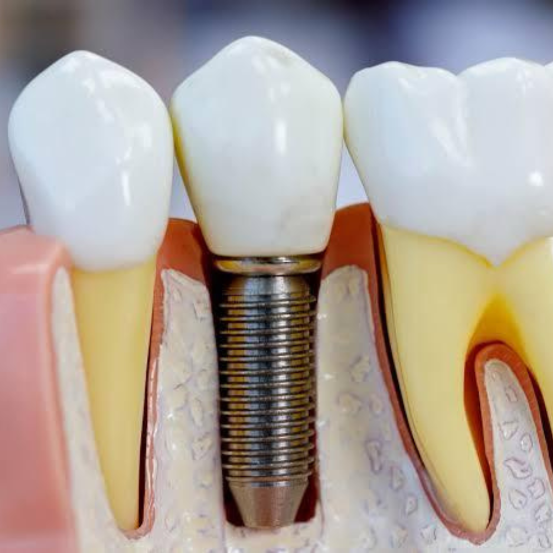 implante dentario (2)