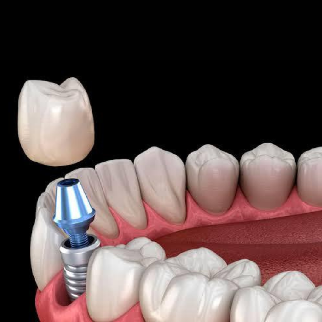 implante dentario (3)