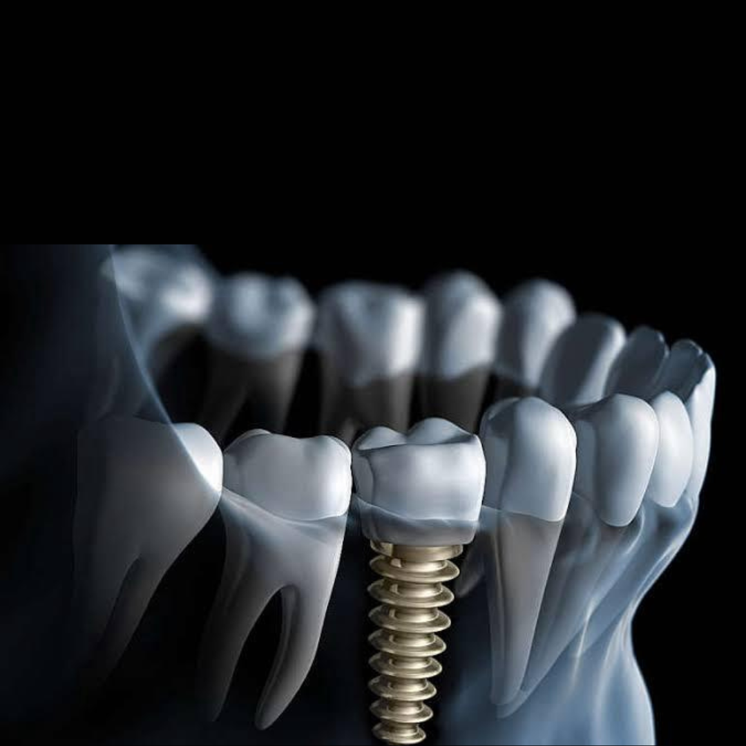 implante dentario (4)